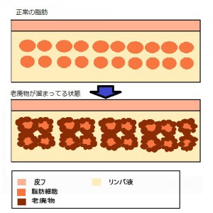 セルライトの表