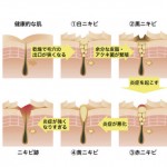 ニキビの原因