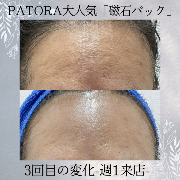 リンパテック痩身1回の変化